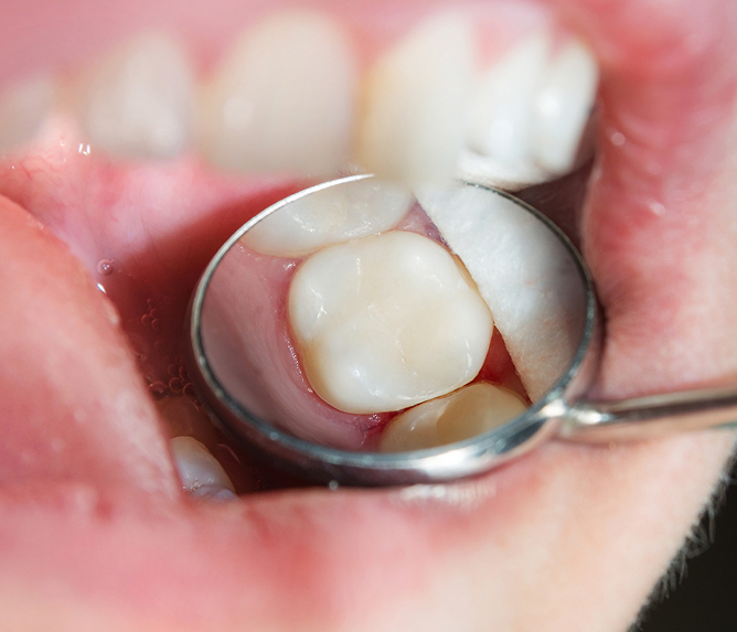 alternatives to mercury fillings