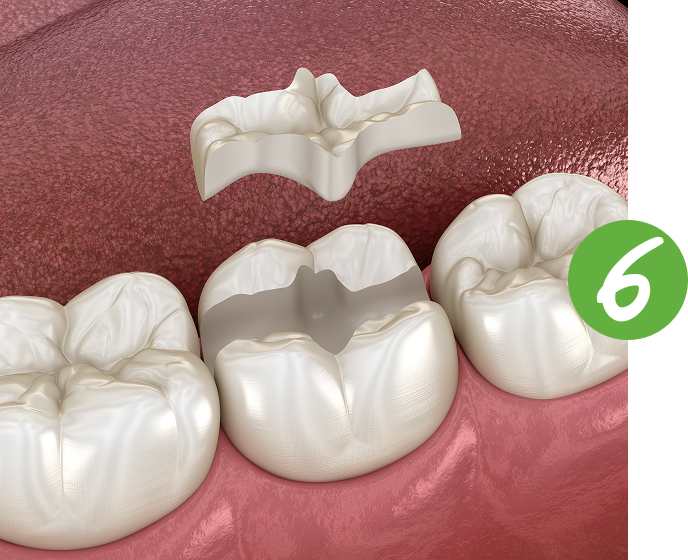 biocompostable dental filling - Biological dentist in Coral Springs