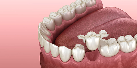 dental crown ceramic
