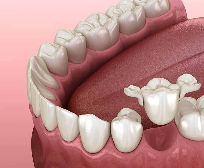 biometric restorations ceramic crown bridge