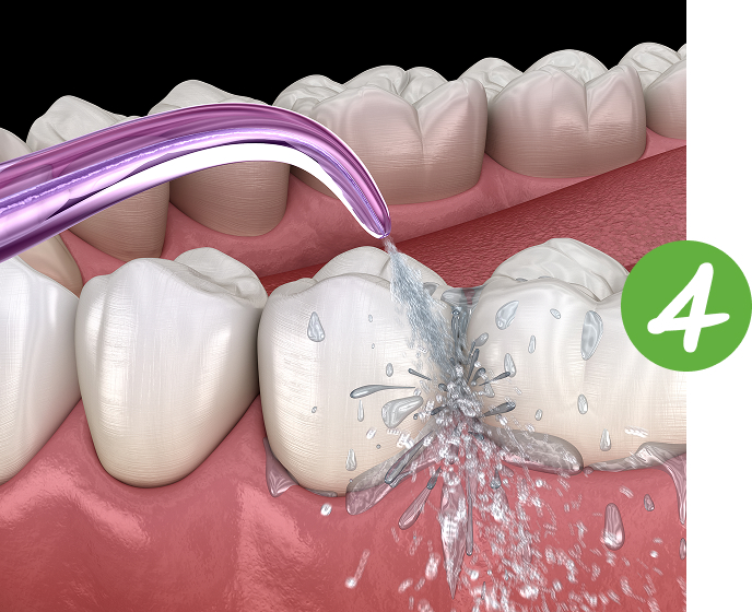 cooling a dental filling