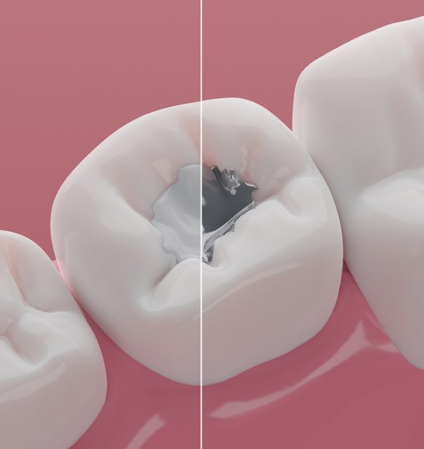 mercury removal - Biological dentist in Coral Springs