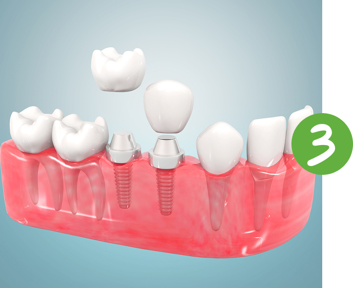 ceramic crown on ceramic plant placement