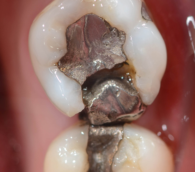 mercury filling