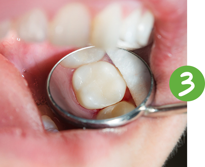 safe dental fillings